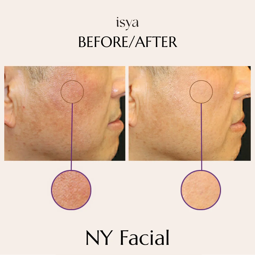 ny facial