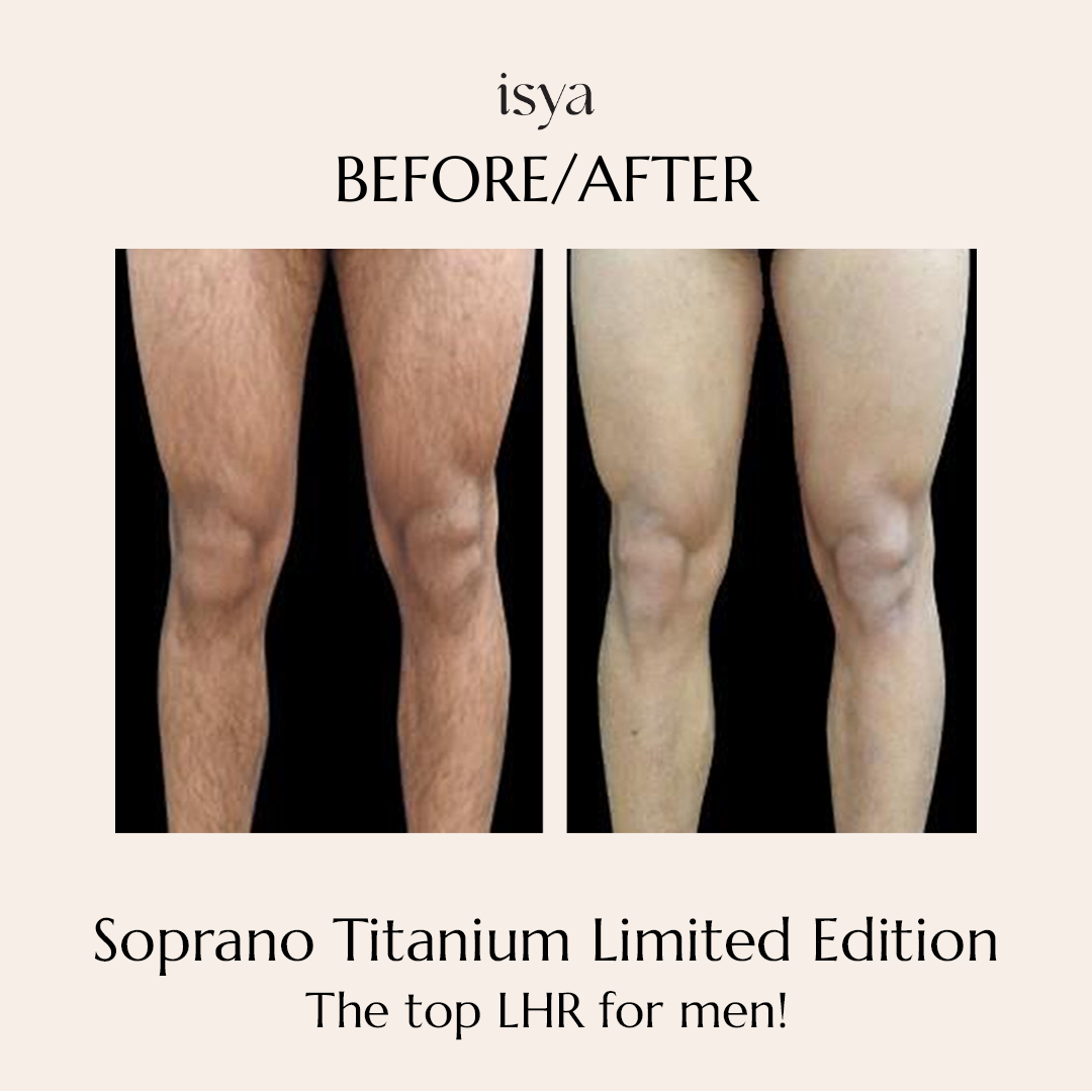 soprano titanium 1