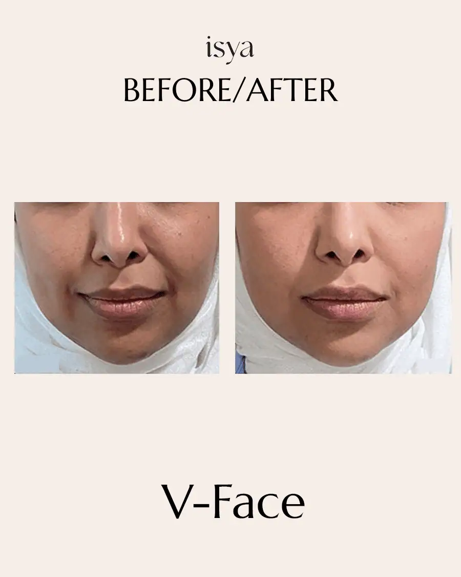 vface 1
