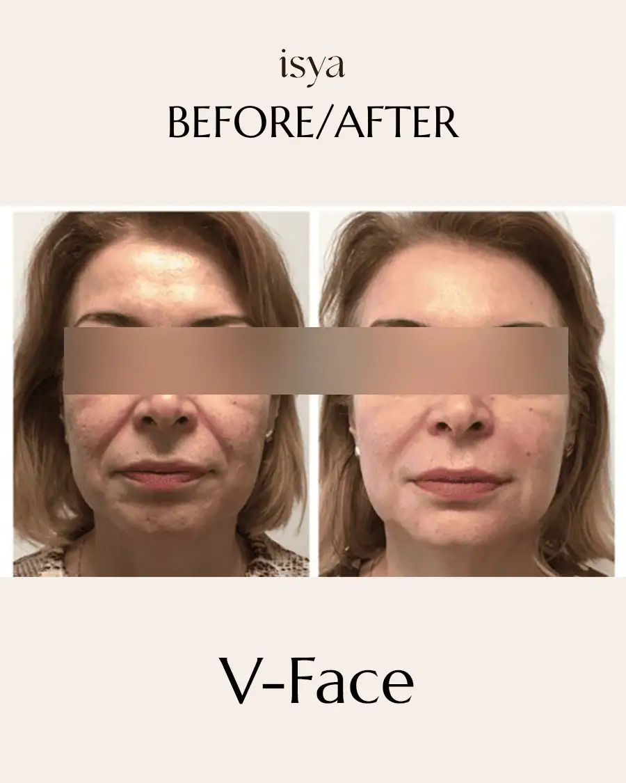 vface 2