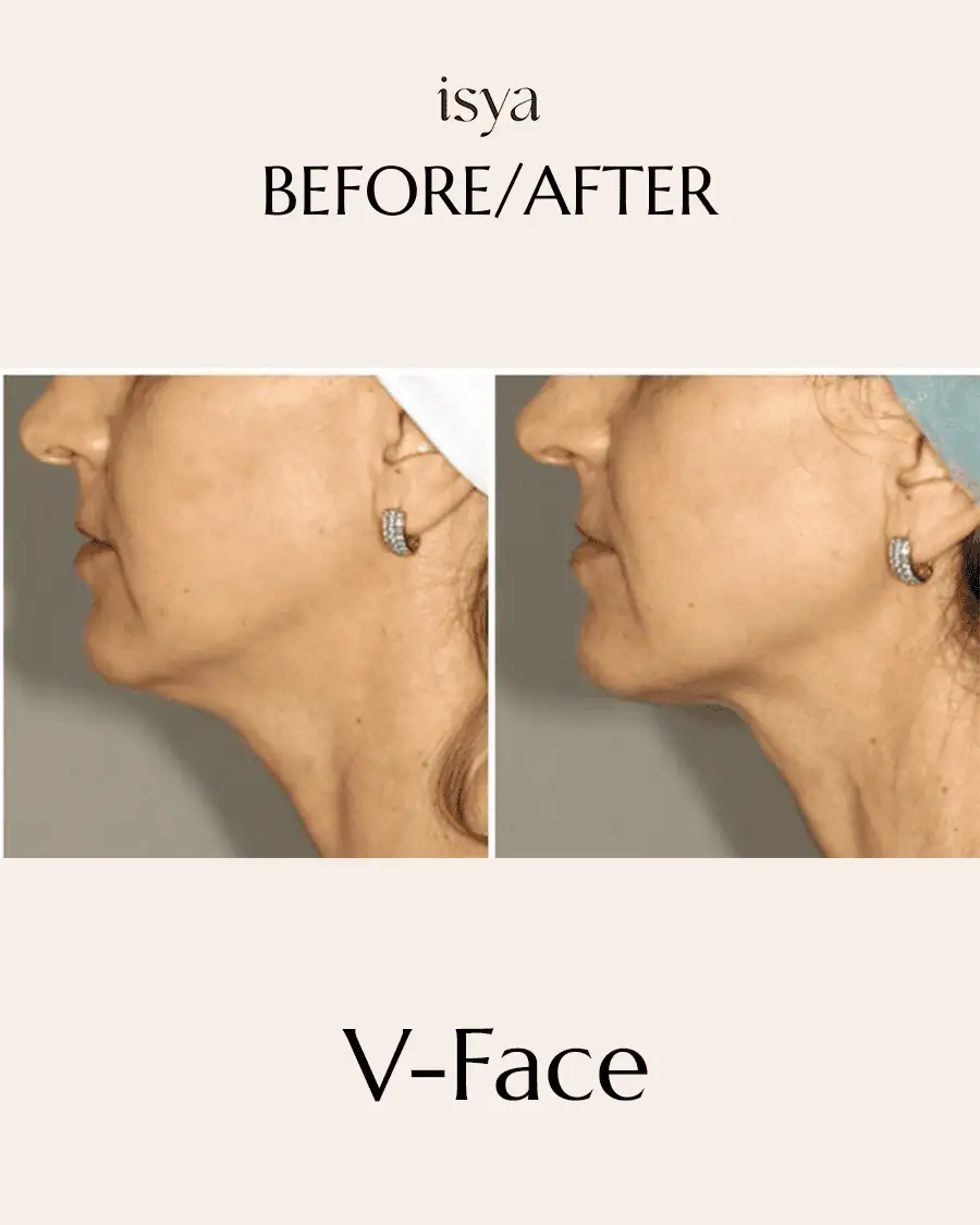 vface 3