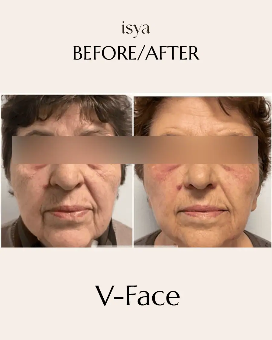 vface 4