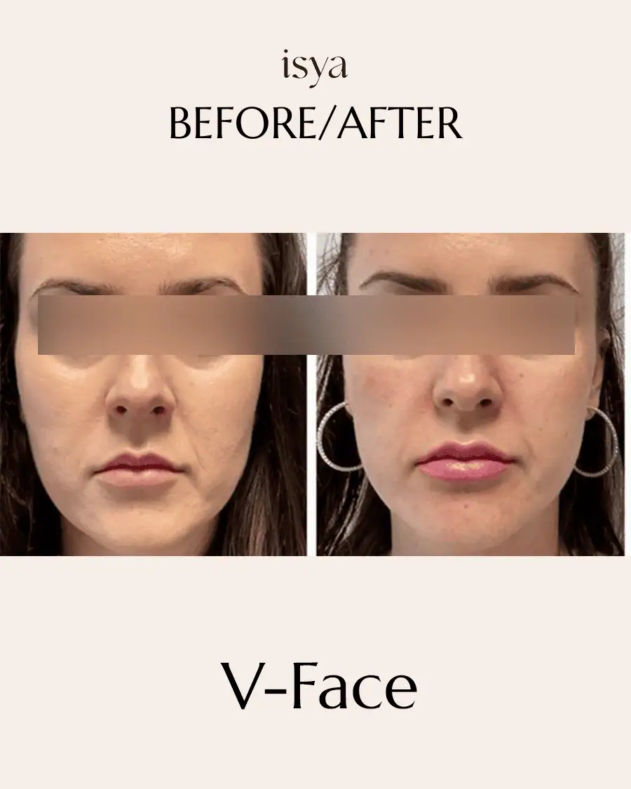 vface 5