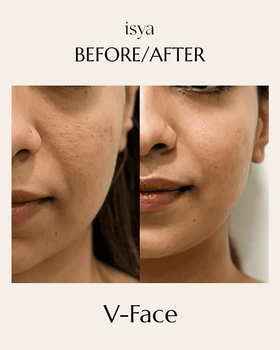 vface