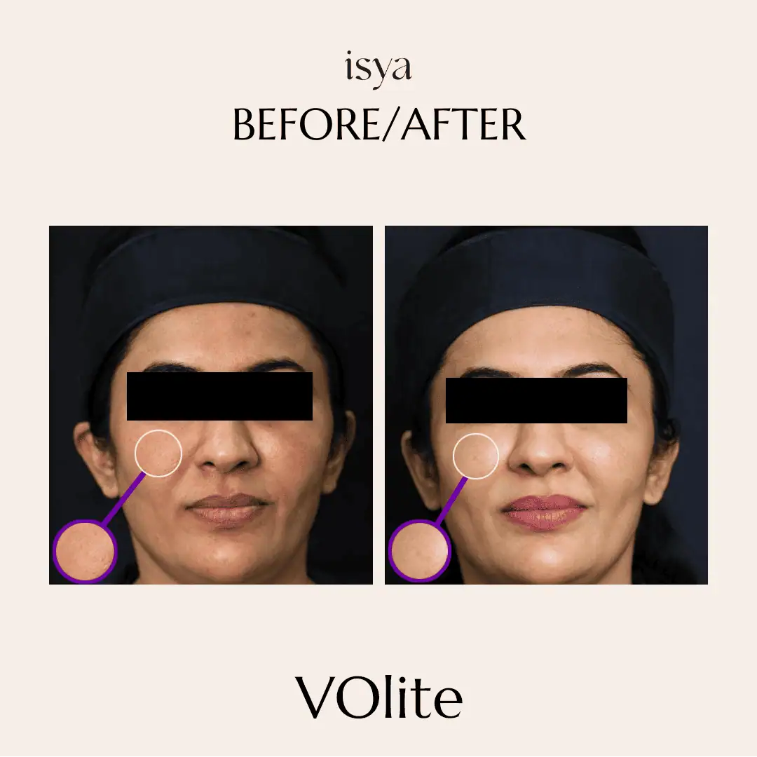 volite1