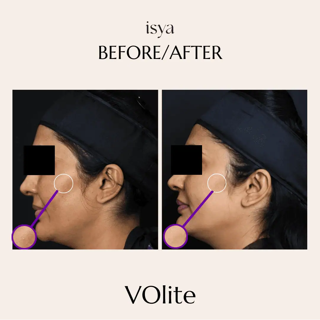 volite2