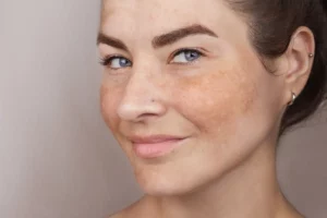 Safe treatments for dark skin patches and pigmentation