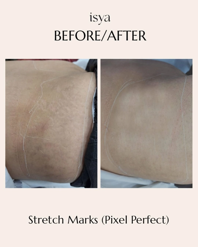 Stretch Marks Treatment