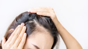 Female pattern Hair Loss