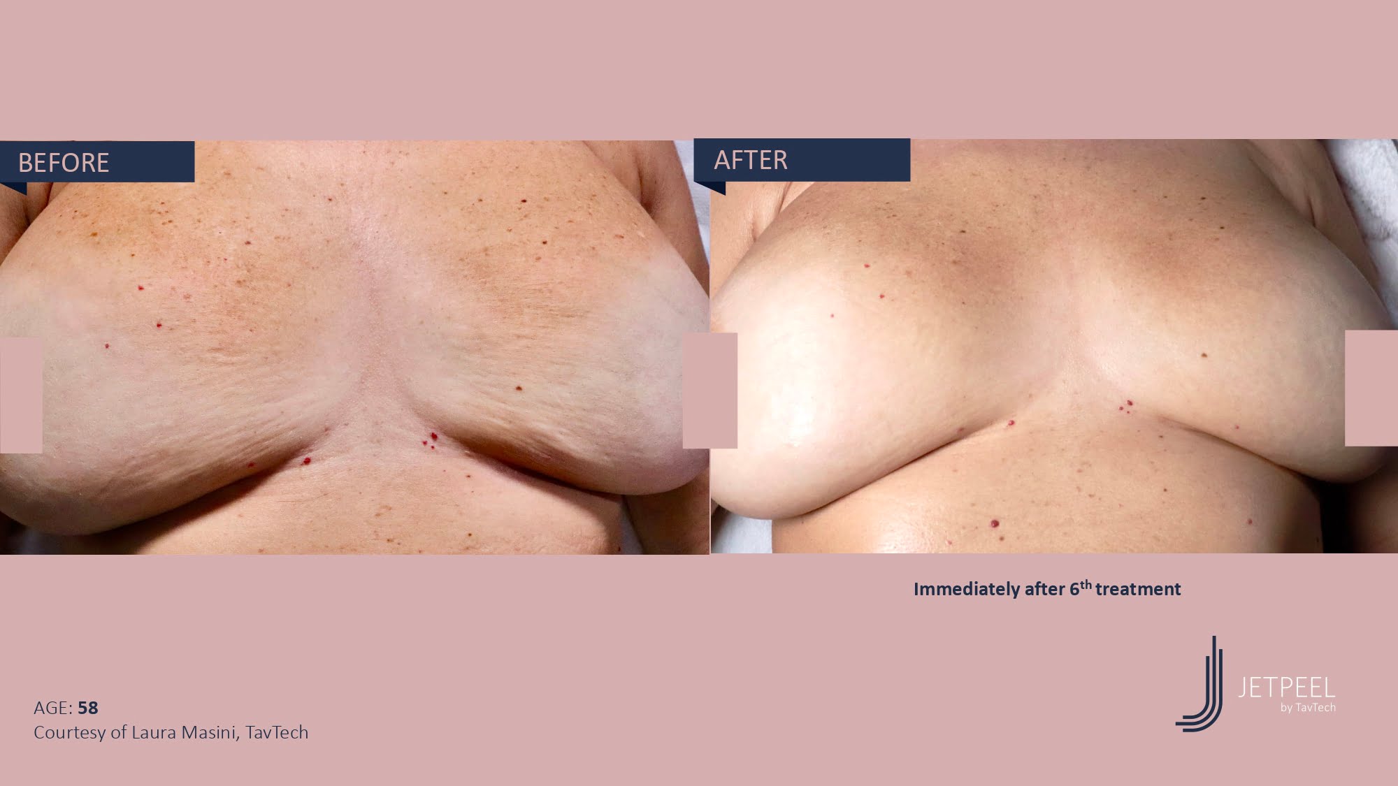 Stretch Marks & Scars (2)