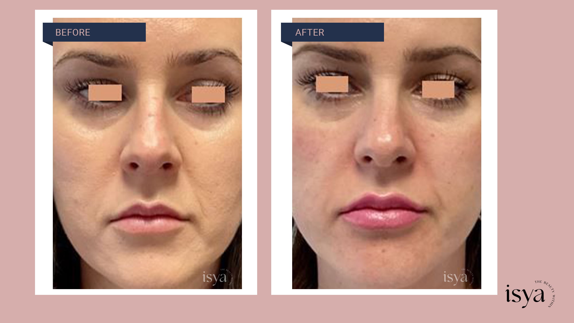 Nonsurgical Facelifts in Denver, CO | Orenda MedSpa